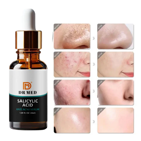 Anti-Acne Serum: (For oil control and acne removal 30ml